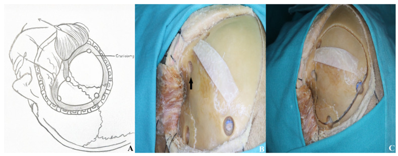 Orbitozygomatic Craniotomy — Figure 5
