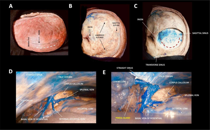 Posterior Cervical Approach — Fig. 2