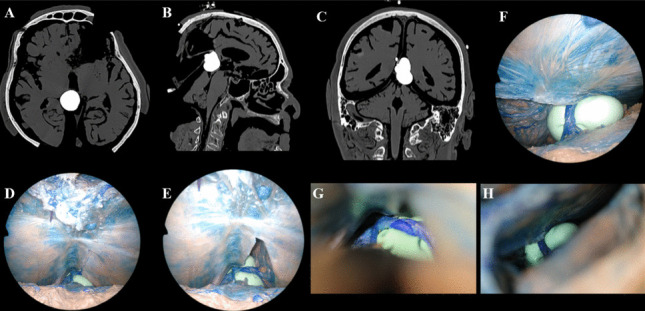 Posterior Cervical Approach — Fig. 4