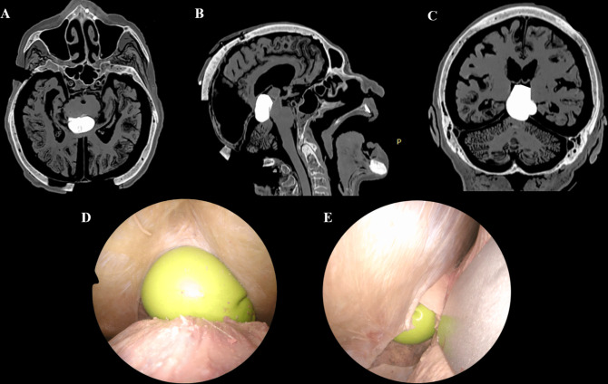 Posterior Cervical Approach — Fig. 5