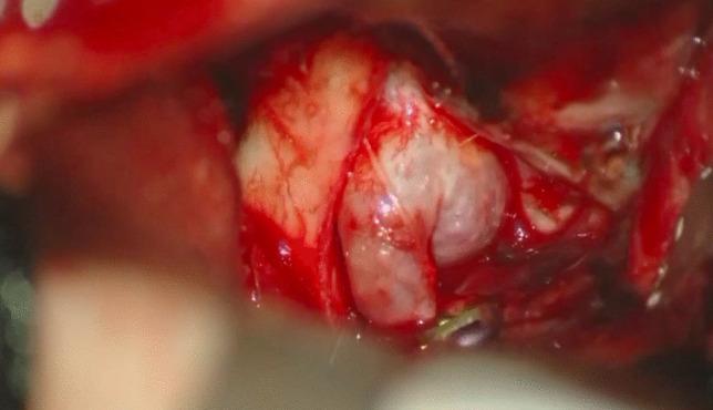 Posterior Cervical Approach — Fig. 2