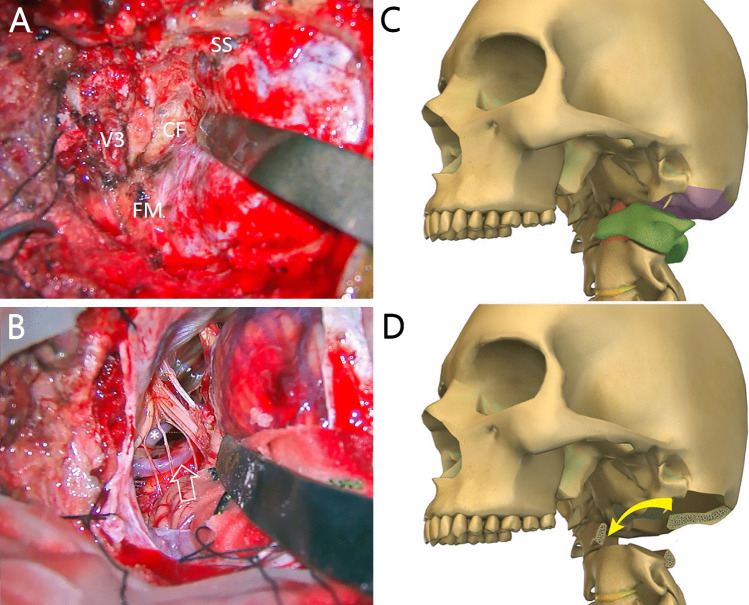 Posterior Cervical Approach — Fig. 5