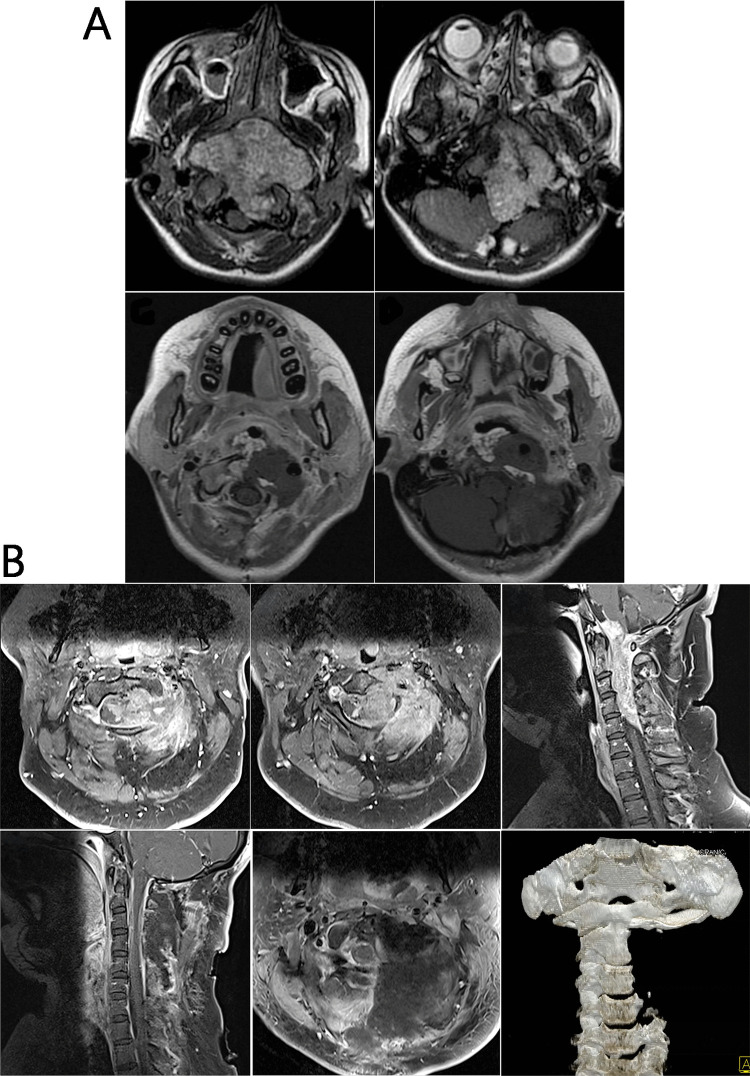 Posterior Cervical Approach — Fig. 6
