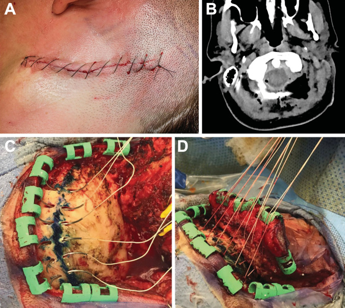 Posterior Cervical Approach — Fig. 7