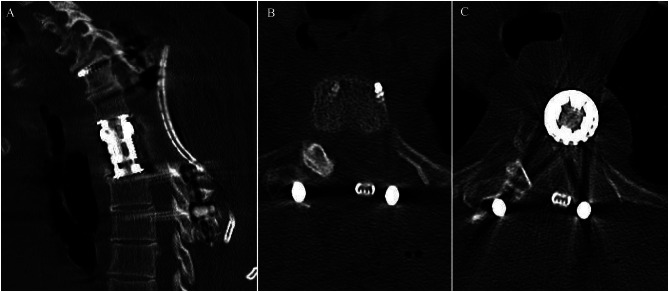 Posterior Thoracolumbar Approach — Fig. 6