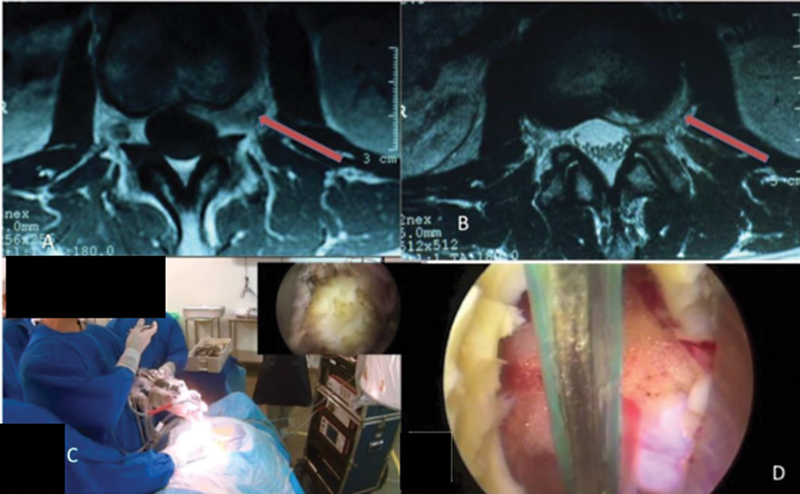 Posterior Thoracolumbar Approach — Fig. 2