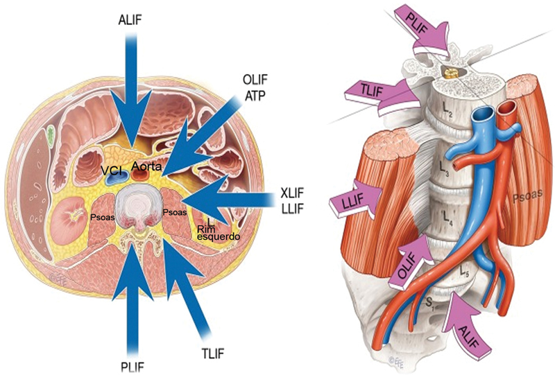 Posterior Thoracolumbar Approach — Fig. 1