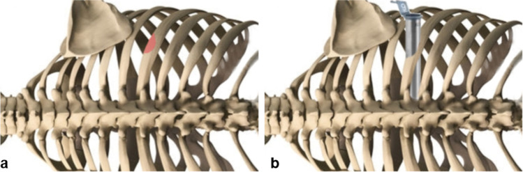 Posterior Thoracolumbar Approach — Fig. 1