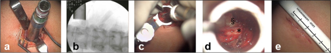 Posterior Thoracolumbar Approach — Fig. 2