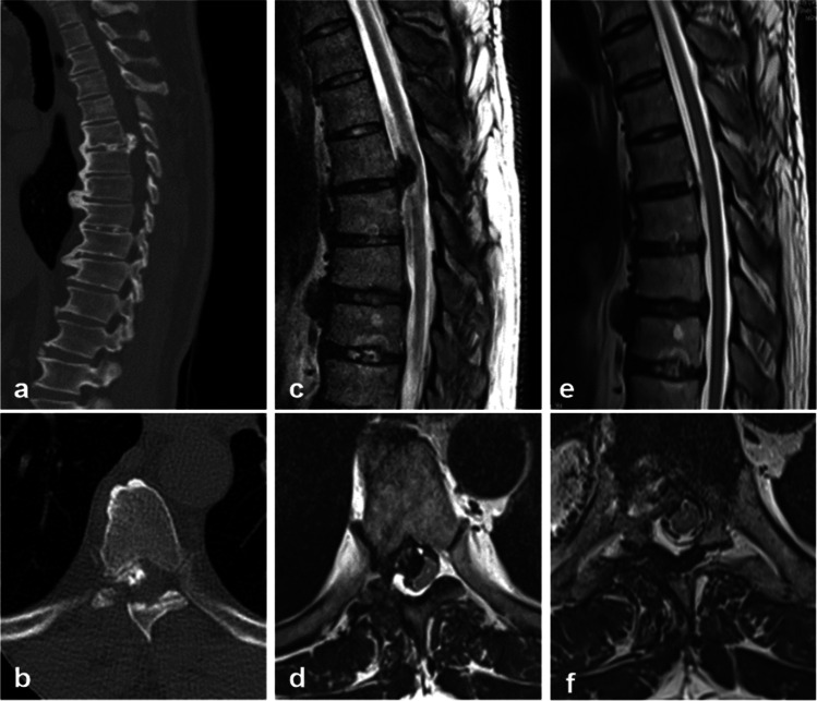 Posterior Thoracolumbar Approach — Fig. 3