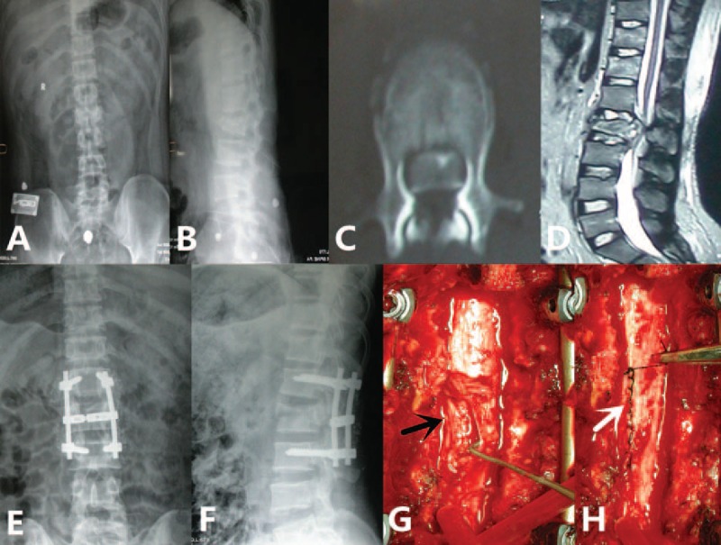 Posterior Thoracolumbar Approach — Figure 2