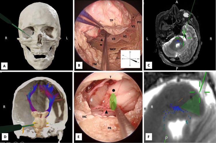 Presigmoid Petrosal Approaches — Fig. 4
