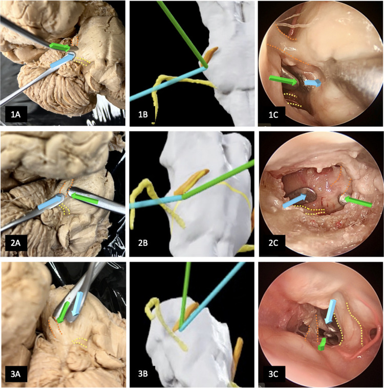 Presigmoid Petrosal Approaches — Fig. 5
