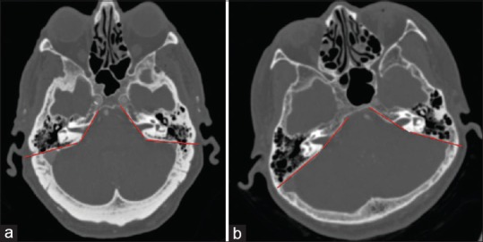Presigmoid Petrosal Approaches — Figure 1