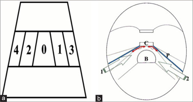 Presigmoid Petrosal Approaches — Figure 1: