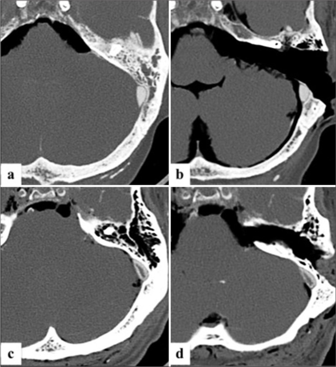 Presigmoid Petrosal Approaches — Figure 2: