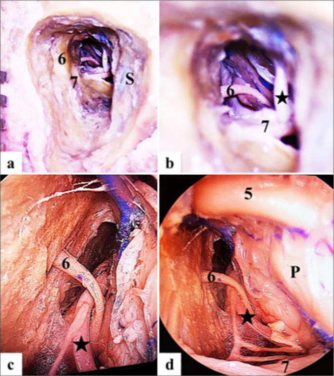 Presigmoid Petrosal Approaches — Figure 3: