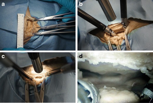 Retrosigmoid Craniotomy — Fig. 2