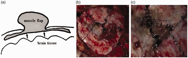 Retrosigmoid Craniotomy — Figure 1.