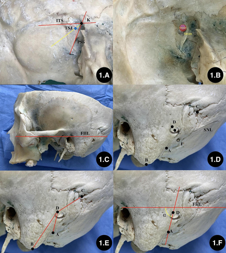 Retrosigmoid Craniotomy — Fig. 1