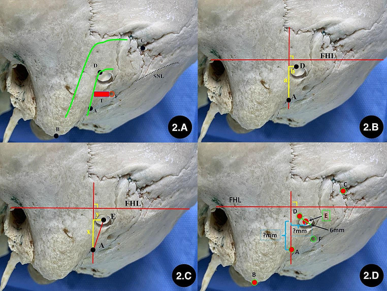 Retrosigmoid Craniotomy — Fig. 2