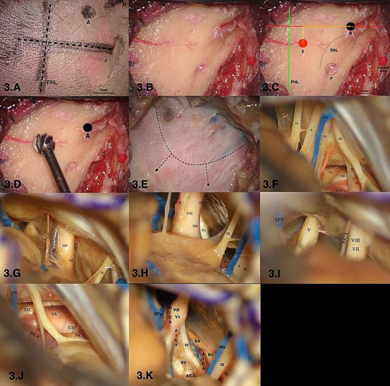 Retrosigmoid Craniotomy — Fig. 3