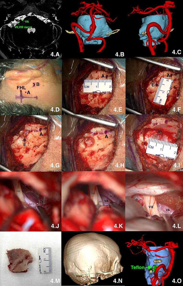 Retrosigmoid Craniotomy — Fig. 4