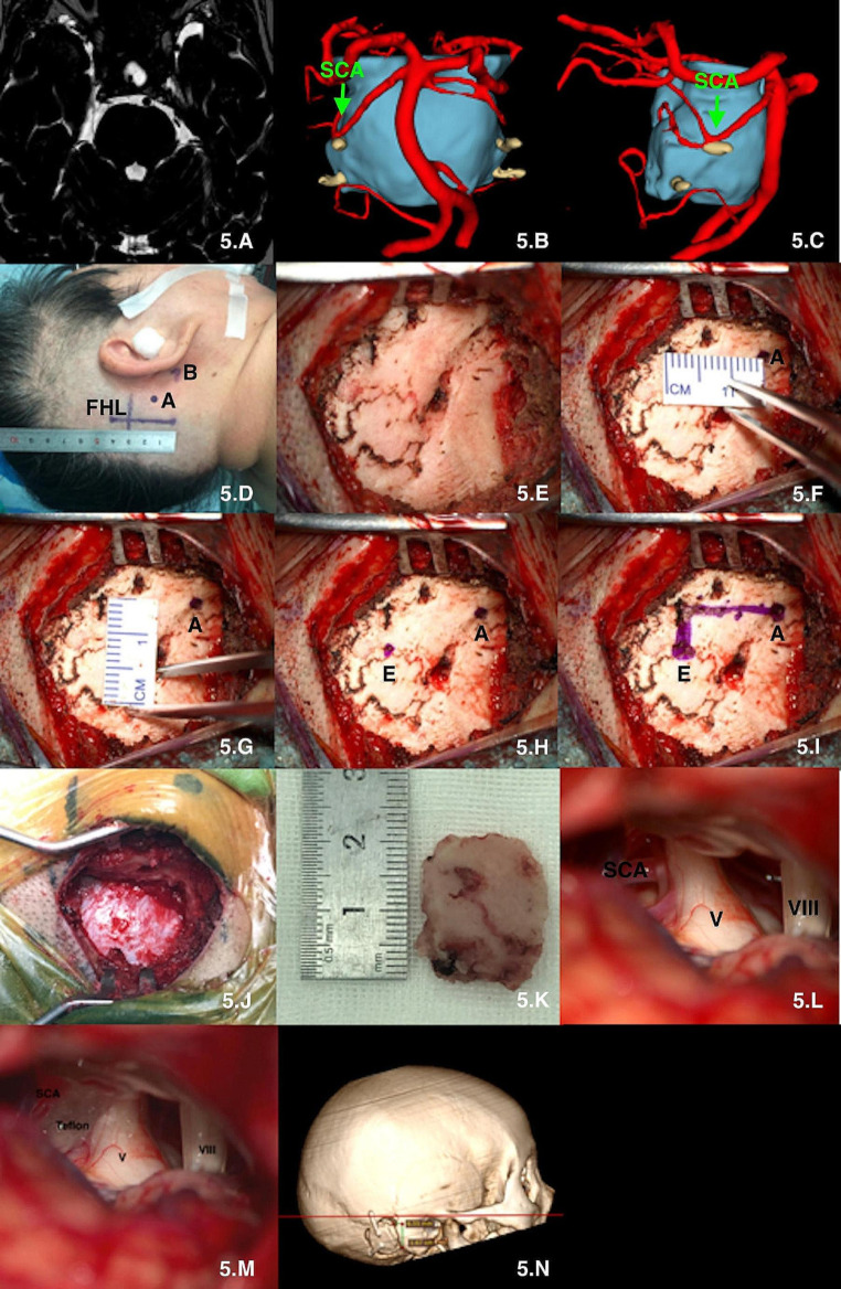 Retrosigmoid Craniotomy — Fig. 5