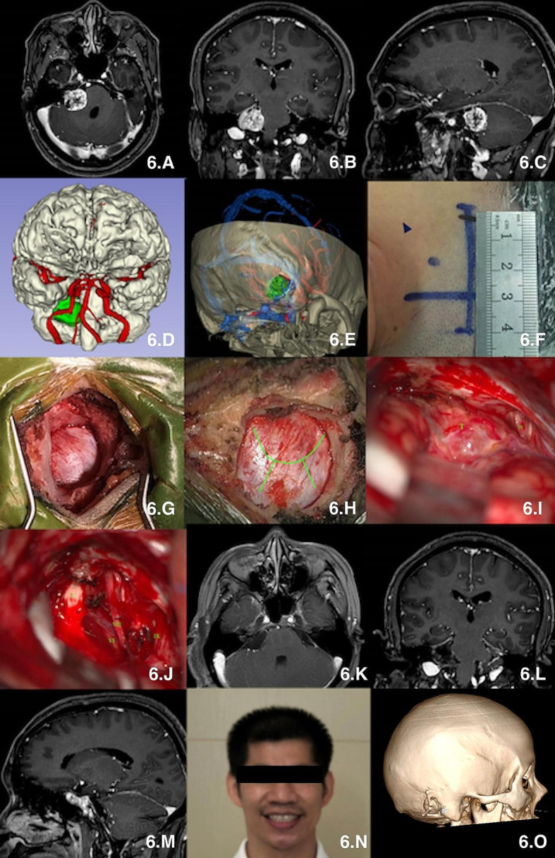 Retrosigmoid Craniotomy — Fig. 6