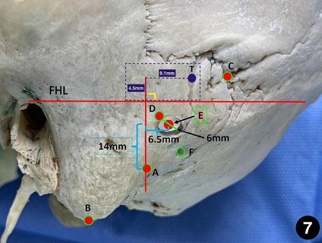 Retrosigmoid Craniotomy — Fig. 7