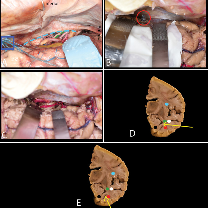 Subtemporal Craniotomy — Fig. 4