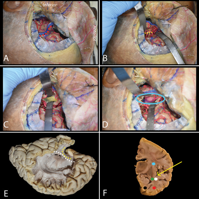 Subtemporal Craniotomy — Fig. 5