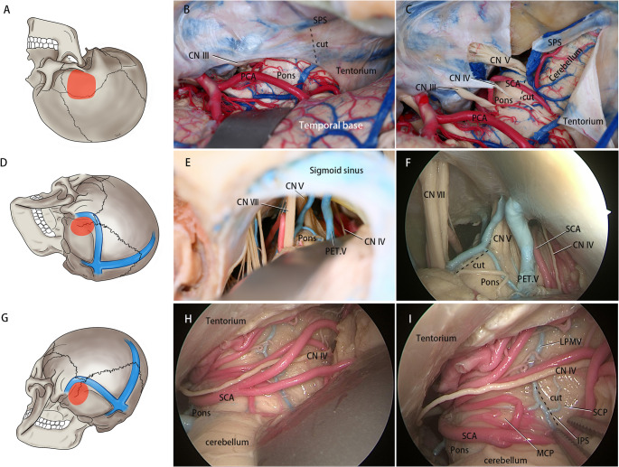 Subtemporal Craniotomy — Fig. 1
