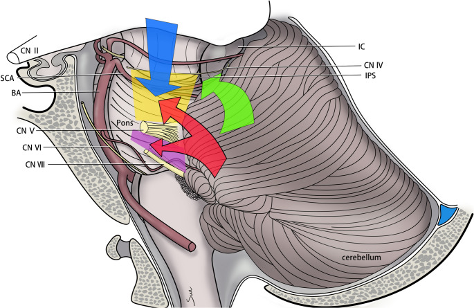Subtemporal Craniotomy — Fig. 4