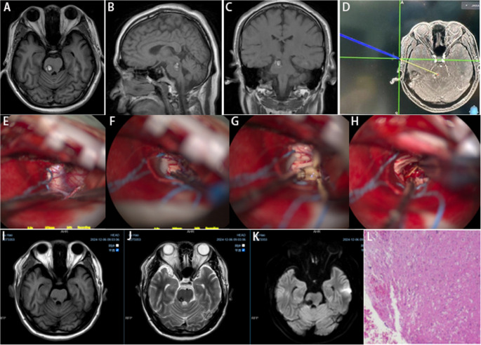 Subtemporal Craniotomy — Fig. 5