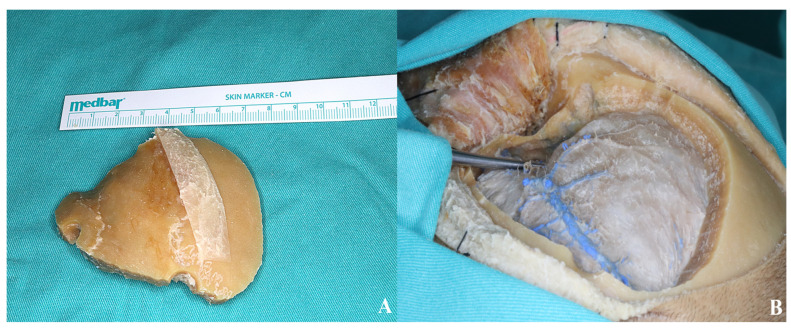 Subtemporal Craniotomy — Figure 6