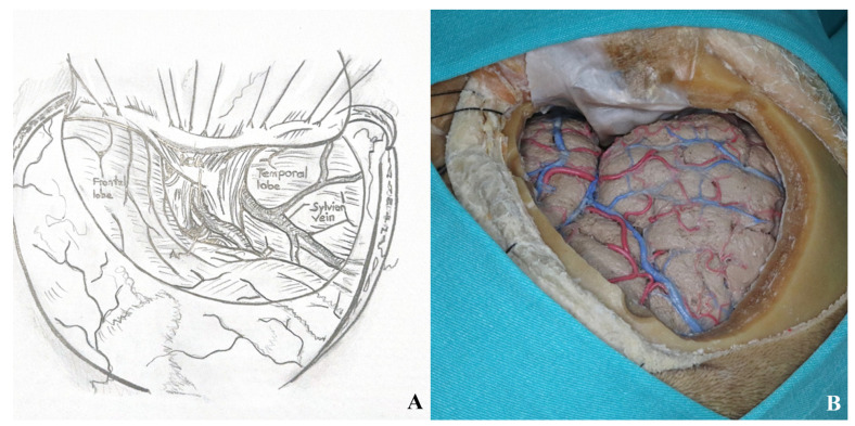 Subtemporal Craniotomy — Figure 7