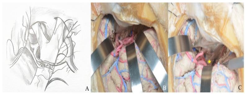 Subtemporal Craniotomy — Figure 8