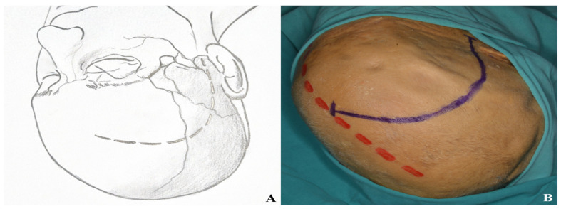 Subtemporal Craniotomy — Figure 9