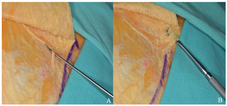 Subtemporal Craniotomy — Figure 10