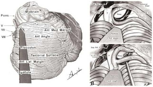 Supracerebellar Infratentorial — Fig. 4