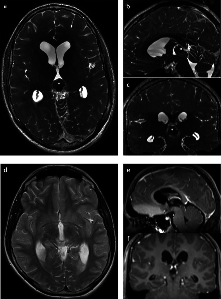 Supracerebellar Infratentorial — Fig. 3