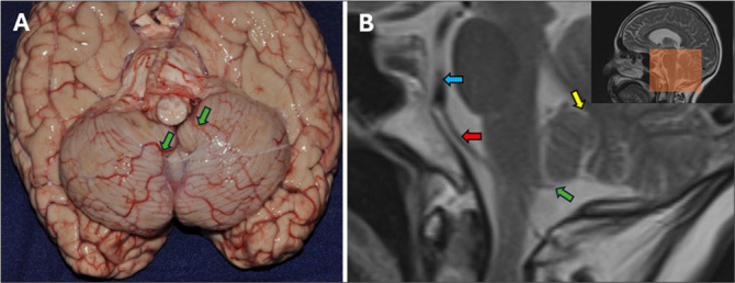 Supracerebellar Infratentorial — Figure 14: