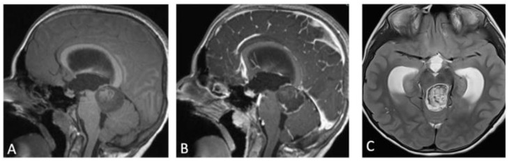 Supracerebellar Infratentorial — Figure 1