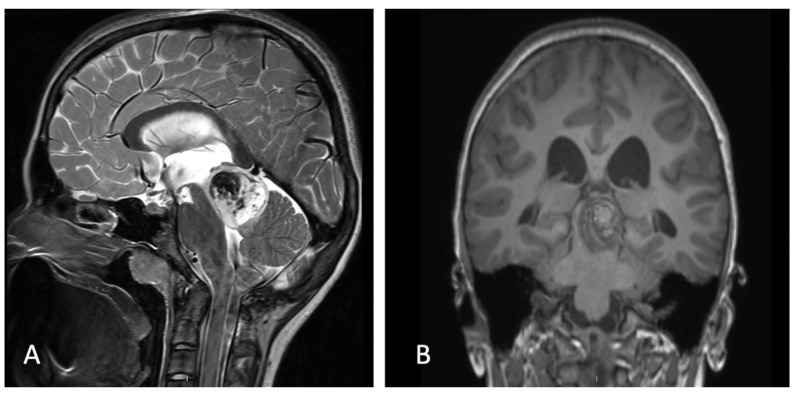 Supracerebellar Infratentorial — Figure 2