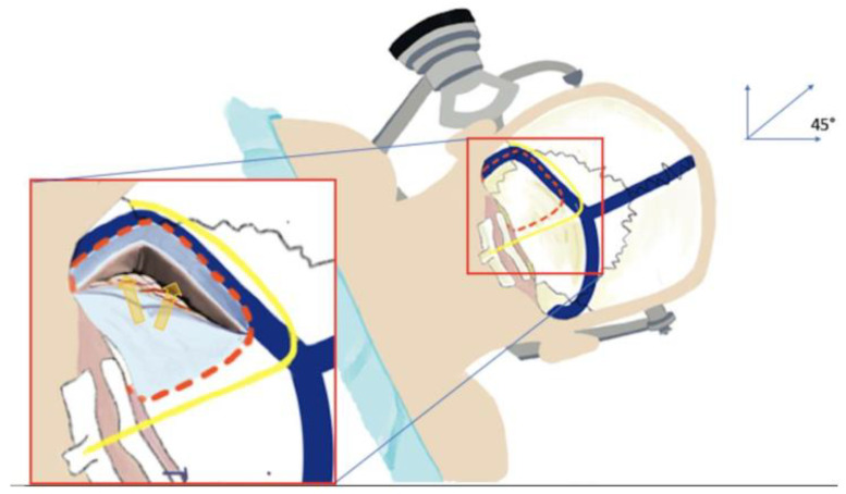 Supracerebellar Infratentorial — Figure 3