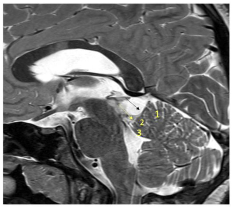 Supracerebellar Infratentorial — Figure 4
