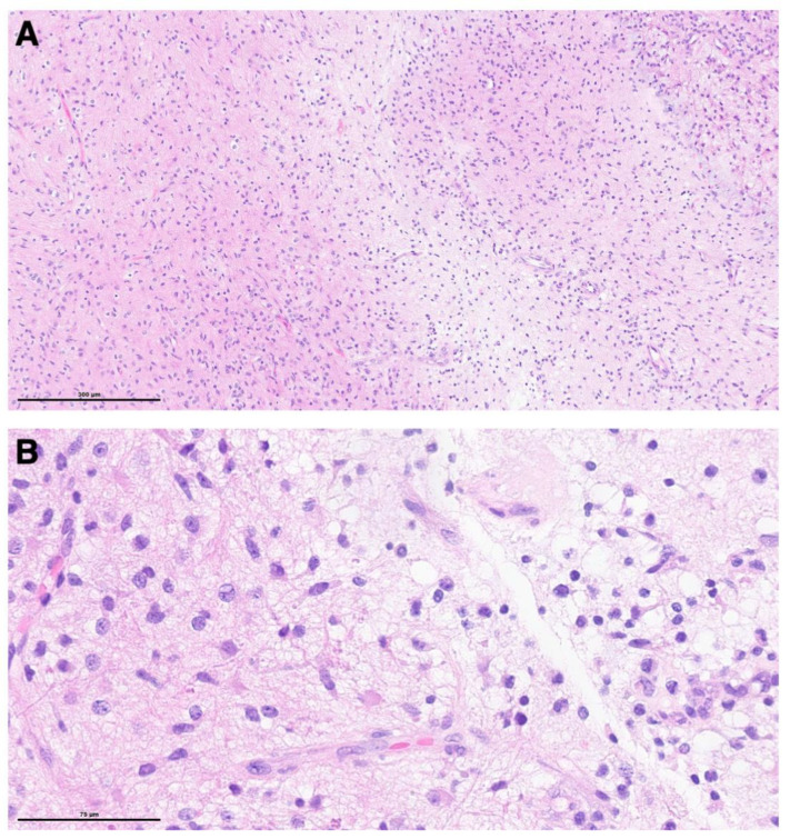 Supracerebellar Infratentorial — Figure 6
