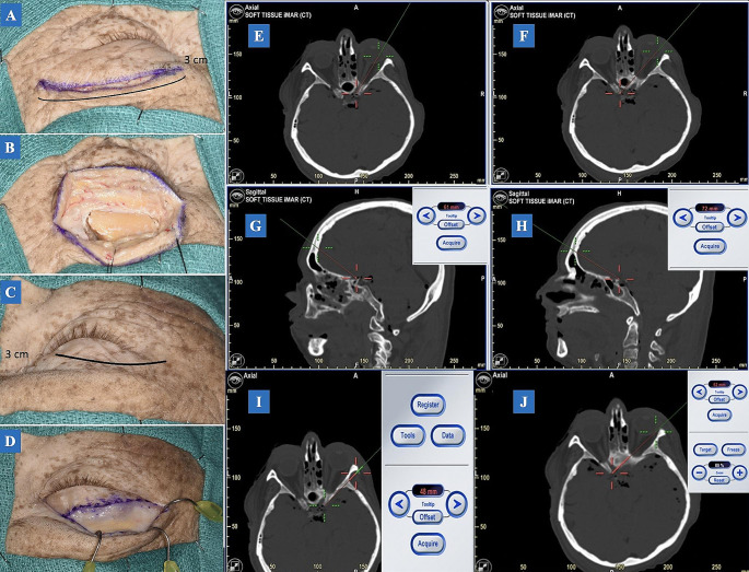 Supraorbital "Eyebrow" Keyhole Craniotomy — Fig. 1