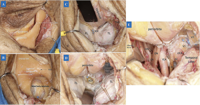 Supraorbital "Eyebrow" Keyhole Craniotomy — Fig. 2